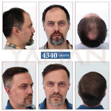 4340 Grafts Before and After