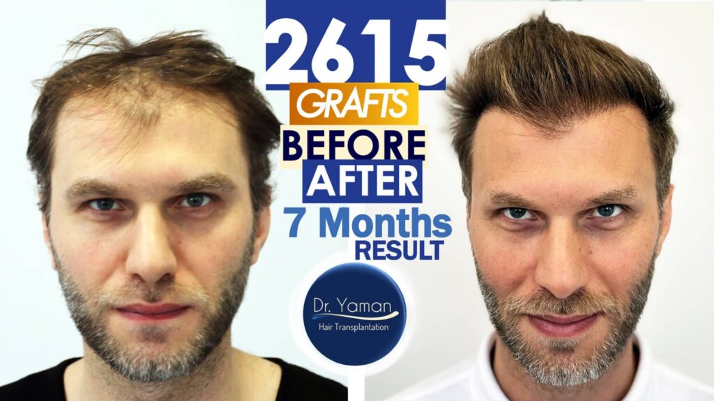 2615 Grafts Before and After
