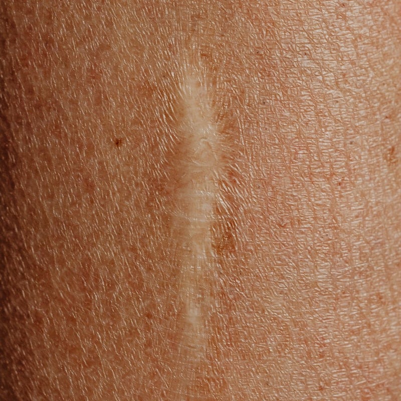 Hair Transplant for Scar Removal - Does it Work?