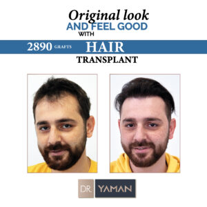 Hair Transplant at 30: Should You Do It?