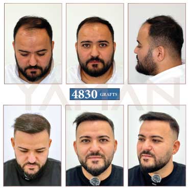4830 Grafts Hair Transplant Before and After Results