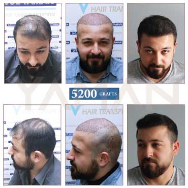 5200 Grafts Before and After Hair Transplant Results
