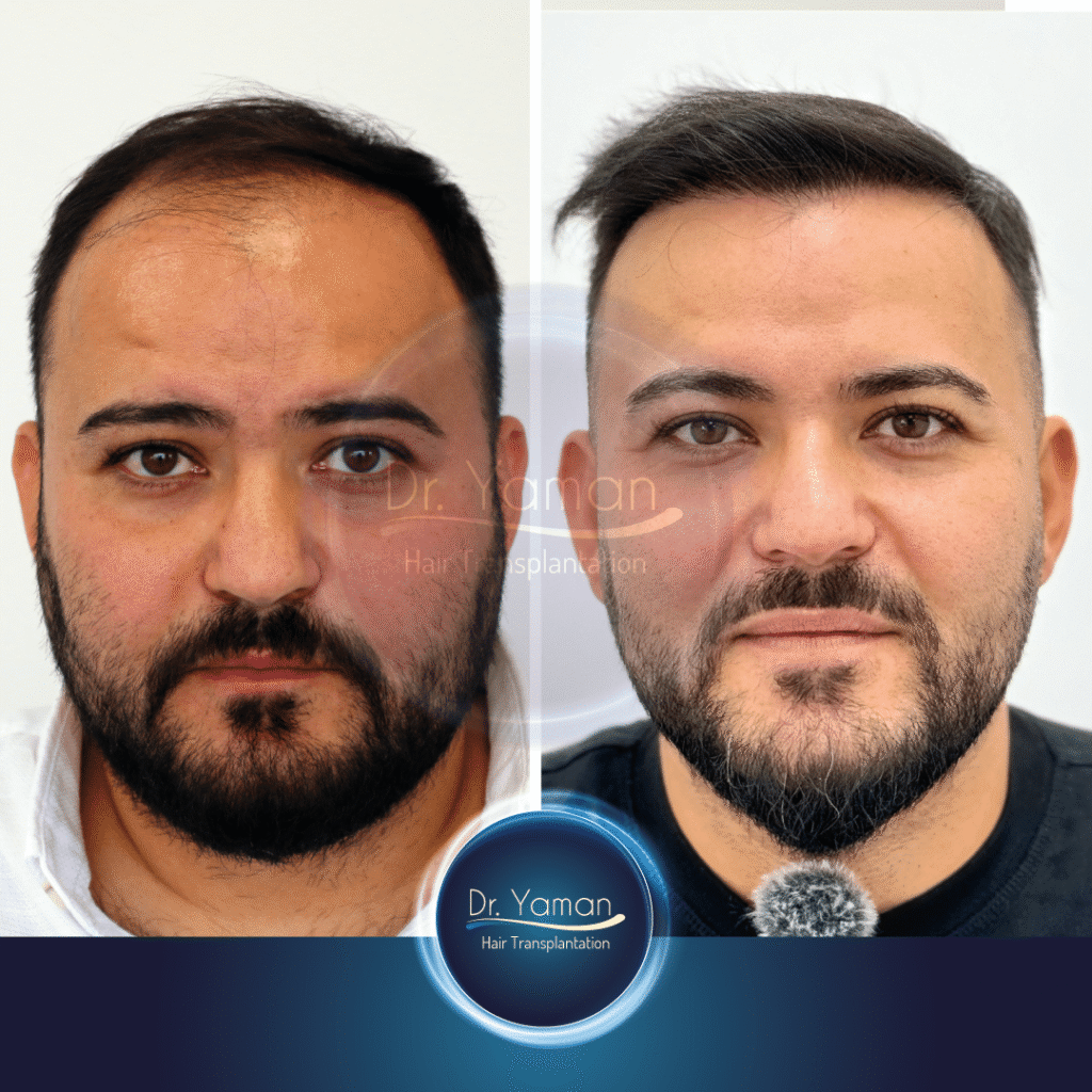 4830 Grafts Hair Transplant Before and After Results