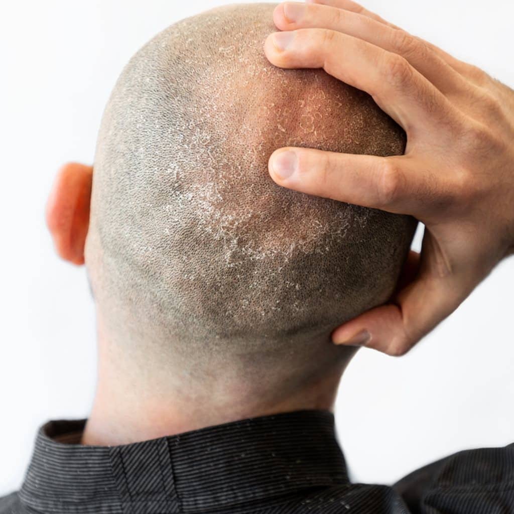 bald head covered with seborrheic dermatitis and dandruff