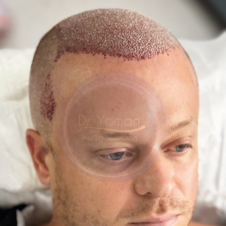 Managing Redness After Hair Transplant