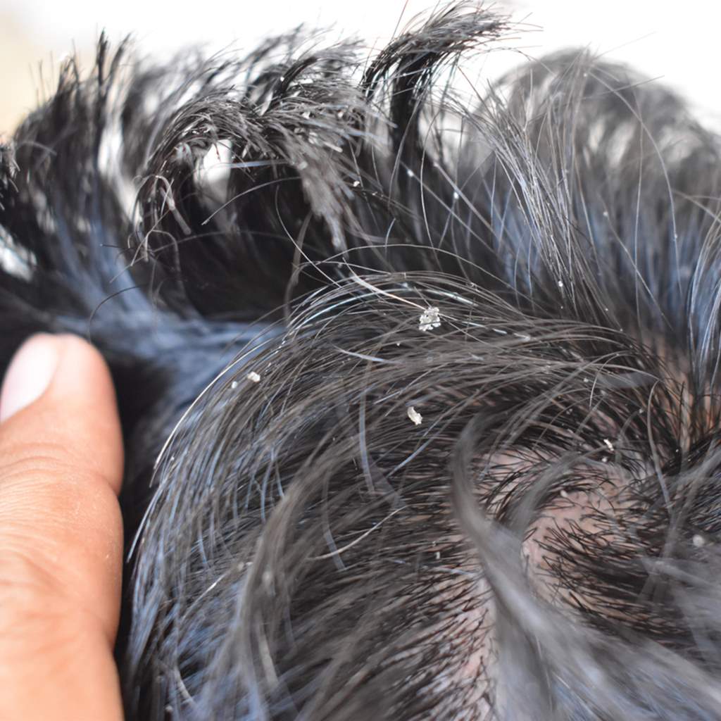 close up top view of hair with dandruff