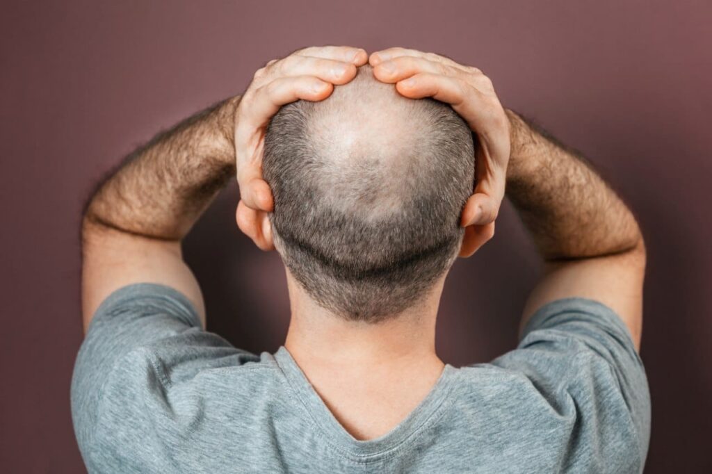 Bad Hair Transplant