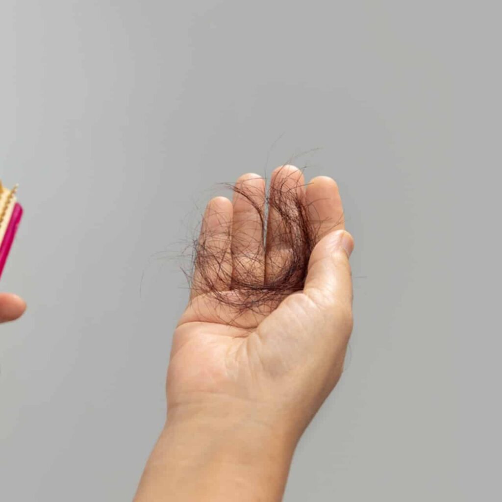 woman holding strands of hair on her hand due to hair loss
