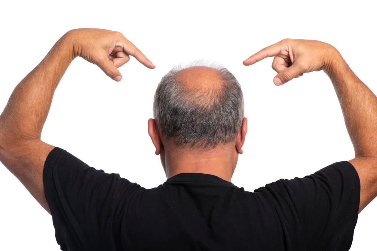 kel noktalarını işaret eden adam