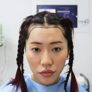 Asian Hair Transplant