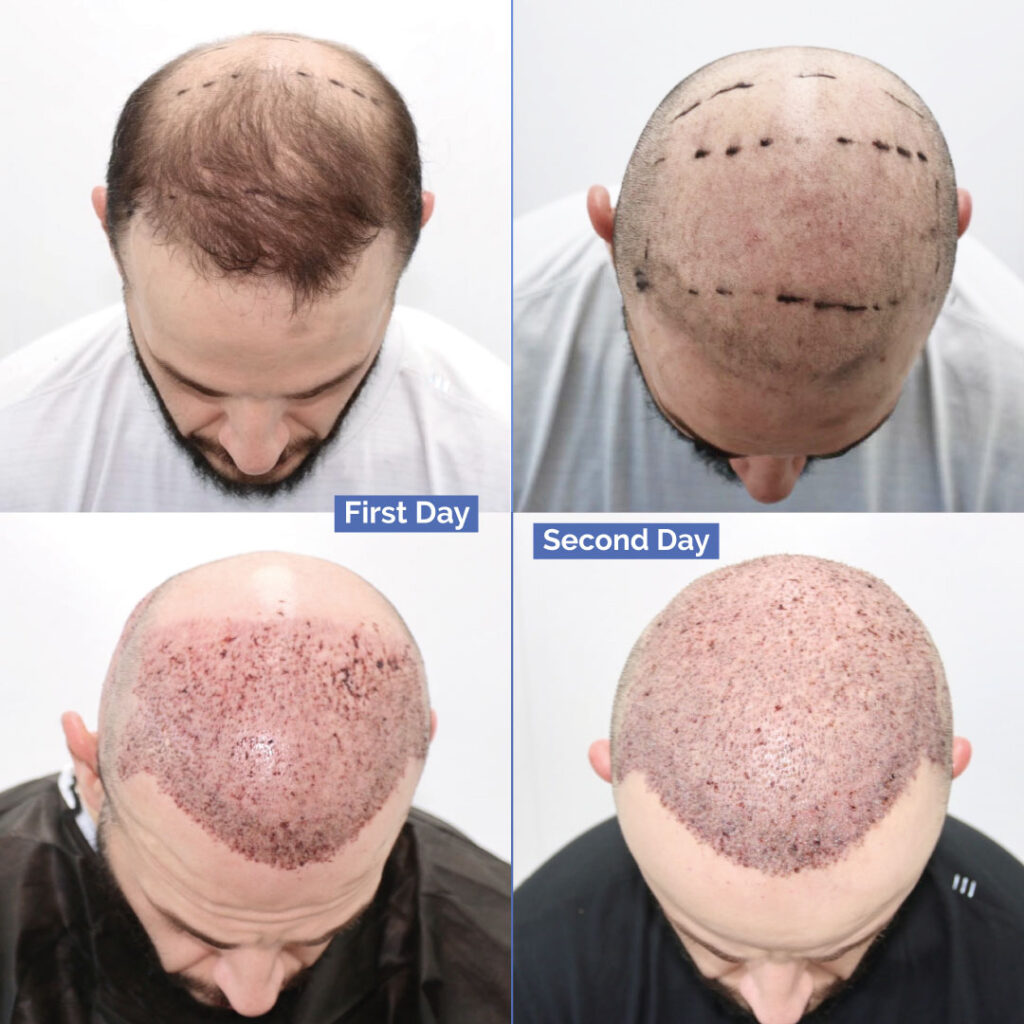 Turkey Hair Transplant Package for DHI