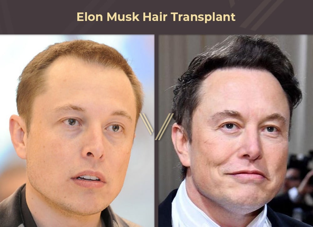 Elon Musk hair transplant