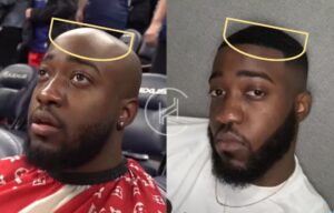 Jidion's Hair Transplant Real