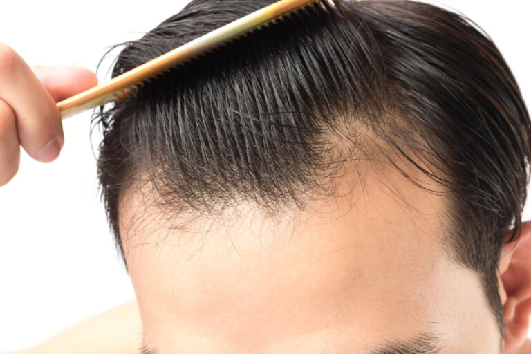 Artificial Hair Transplant