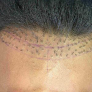 Hair Plugs vs Hair Transplant