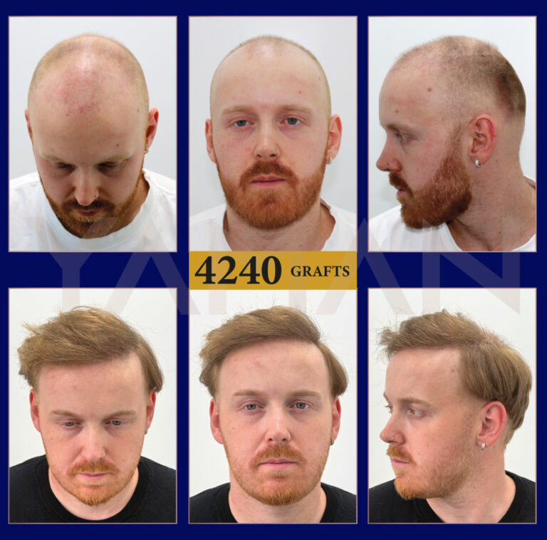 4240 Grafts Hair Transplant Result