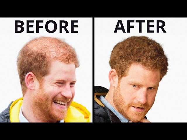 Prince Harry Hair Transplant