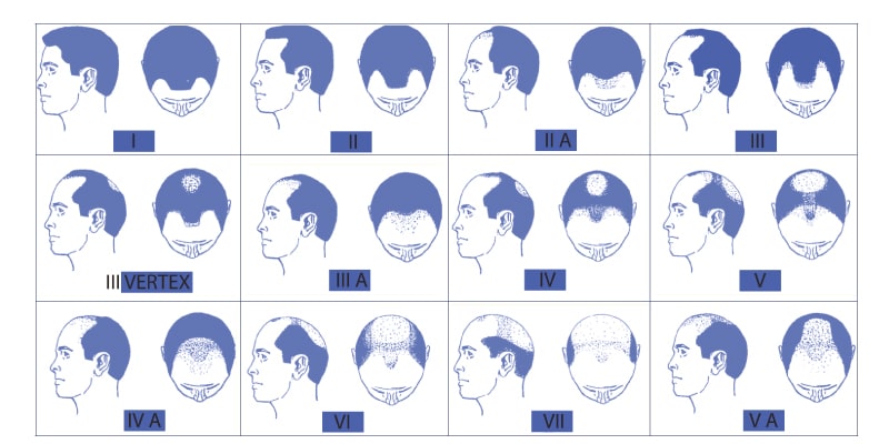 What is the Norwood Scale?