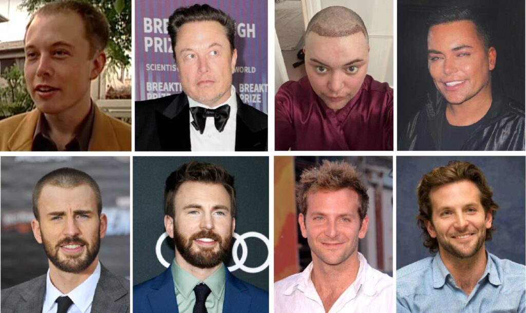 Why Celebrity Hair Transplants Look So Natural?