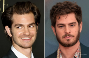 Andrew Garfield Hair Transplant