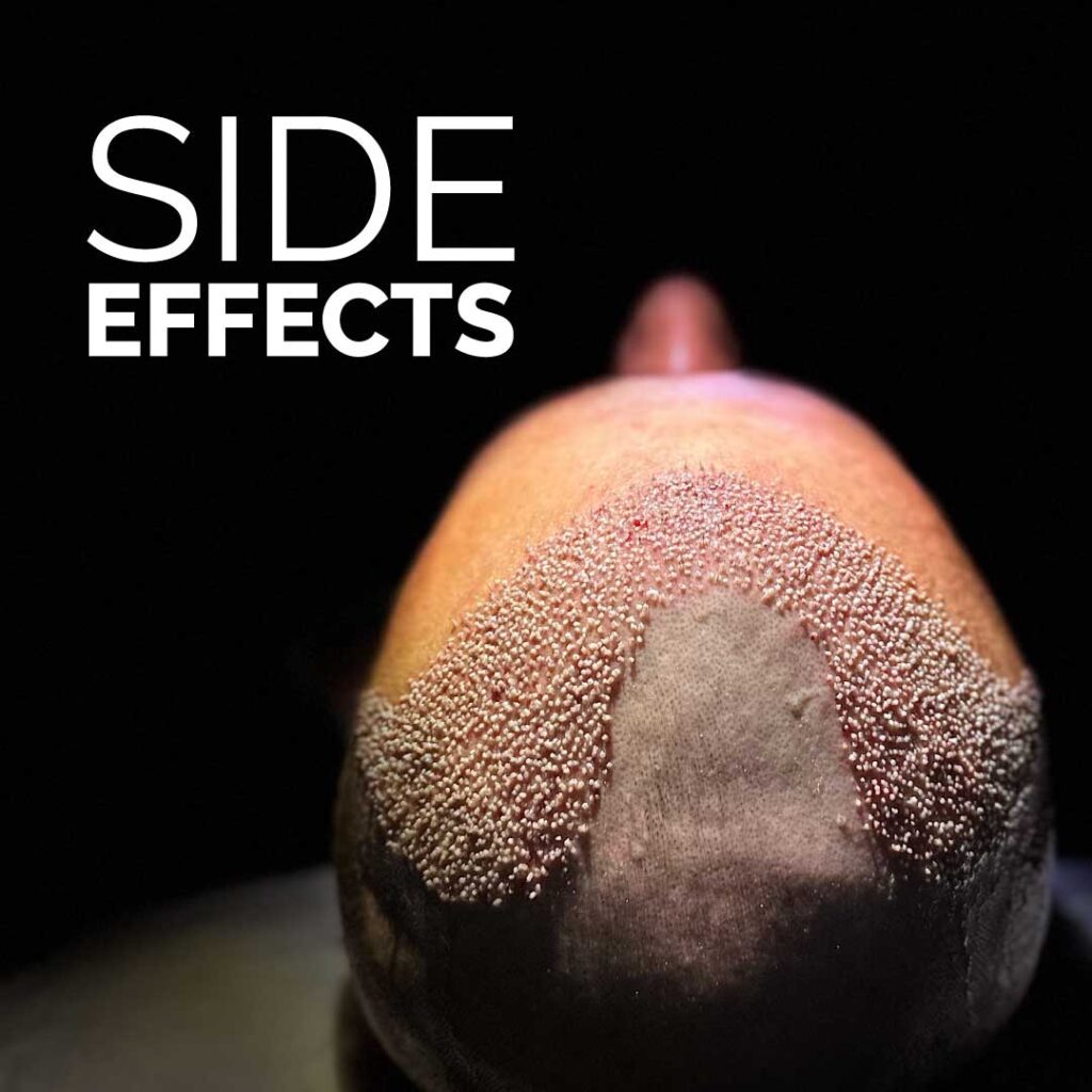 Hair Transplant Side Effects