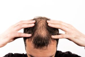 Male Pattern Baldness