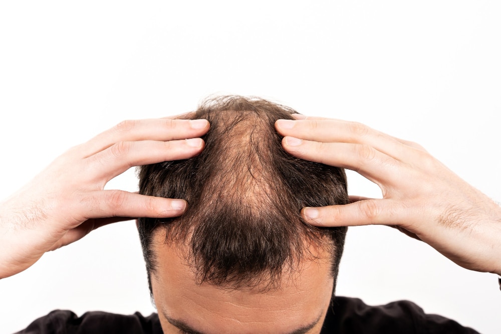 Male Pattern Baldness