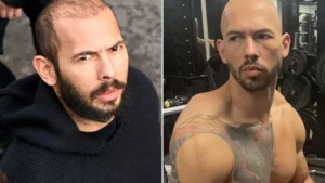 Andrew Tate Hair Transplant