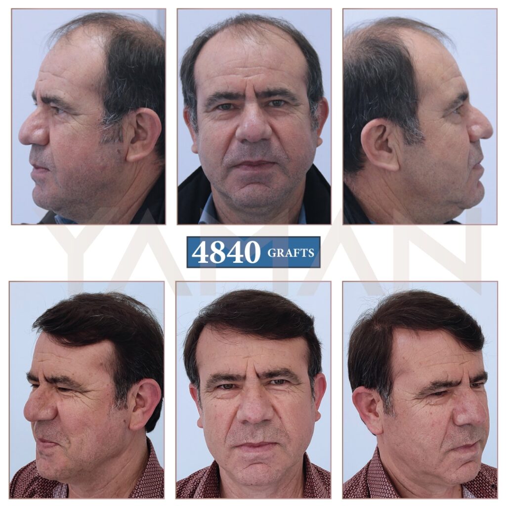 Hair Transplant 4840 Grafts Before and After