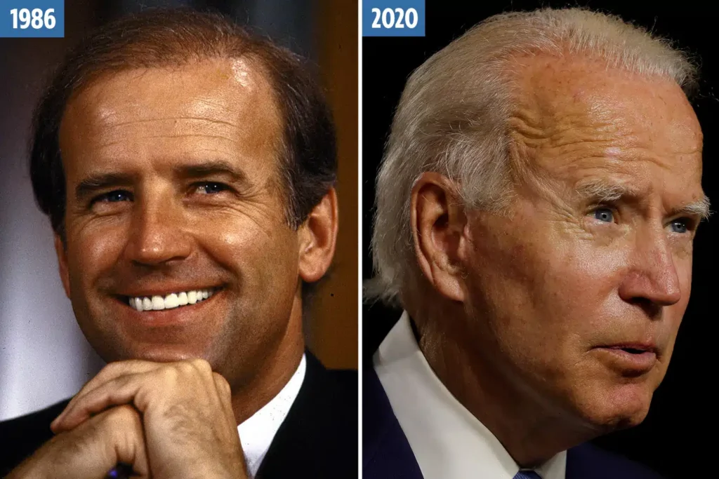 Joe Biden Hair Transplant