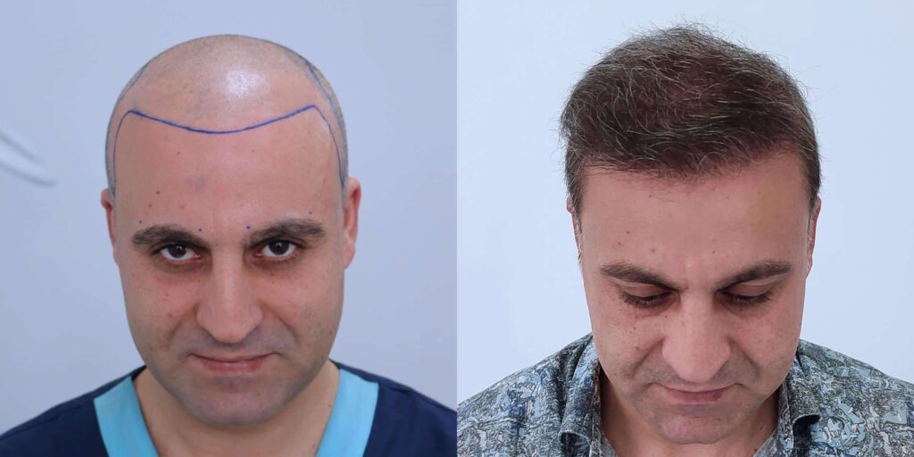What to Expect in Hair Transplant Before and After Photos