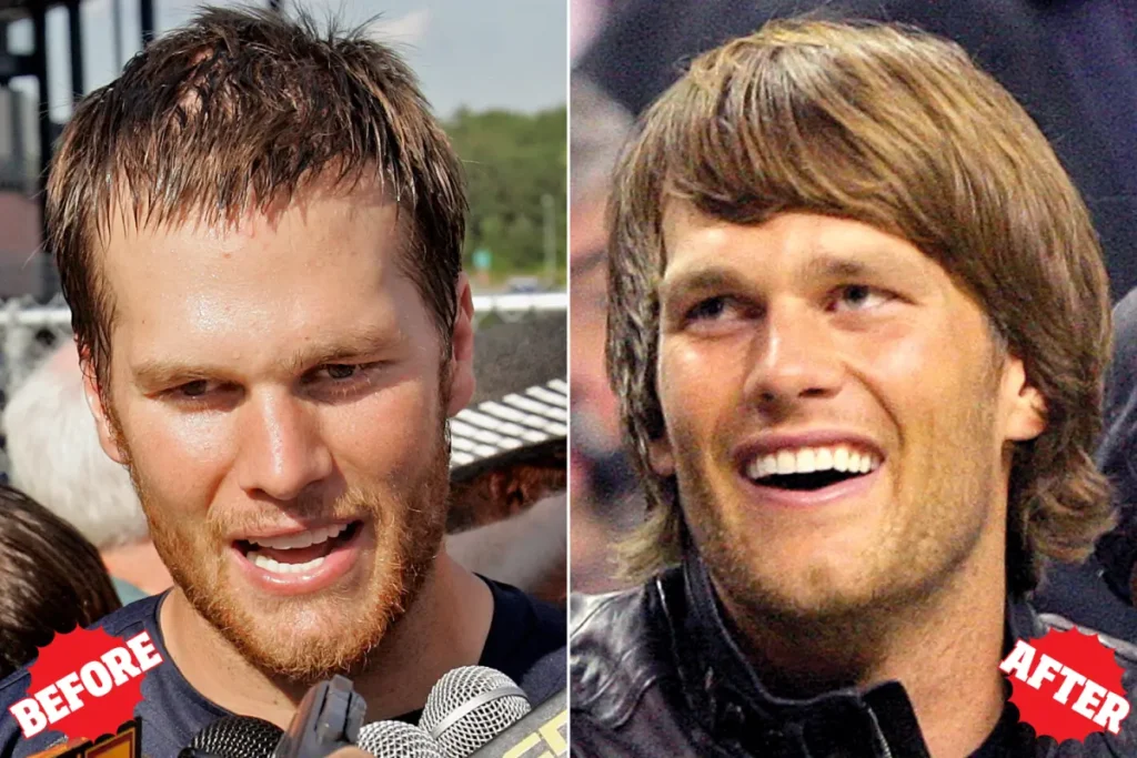 Tom Brady Hair Transplant