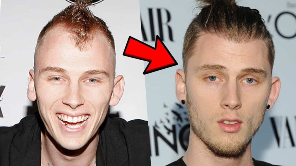 MGK Hair Surgery