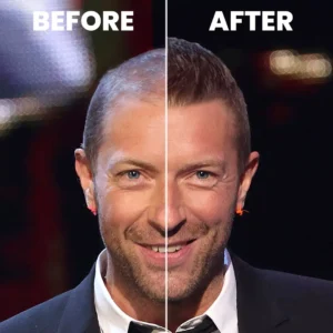 Chris Martin Hair Transplant