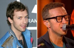 Chris Martin Hair Transplant