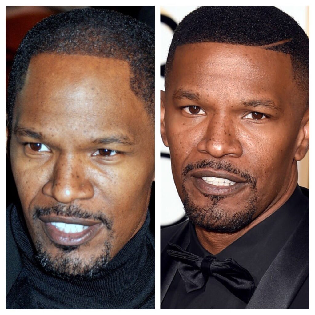 Jamie Foxx Hairline Surgery