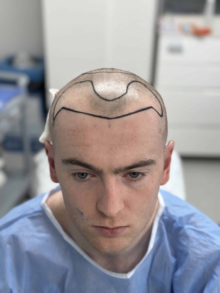 Temple Hair Transplant in Turkey