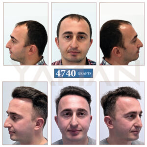 4740 Grafts Hair Transplant