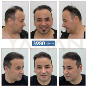 3980 Grafts Hair Transplant