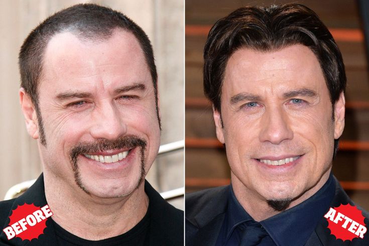 John Travolta Hair Transplant