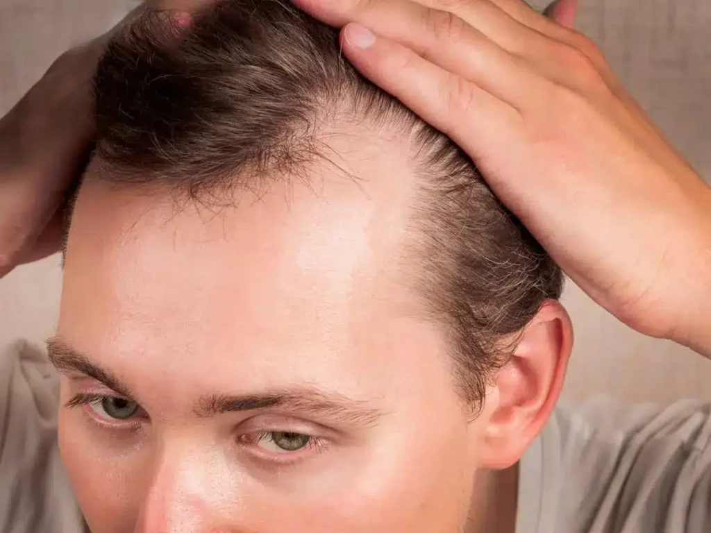 M-Shaped Hairline