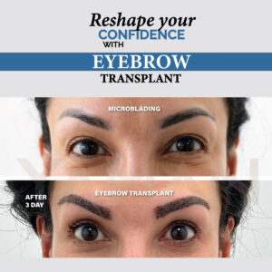 Thicker Brows with Eyebrow Transplant in Turkey