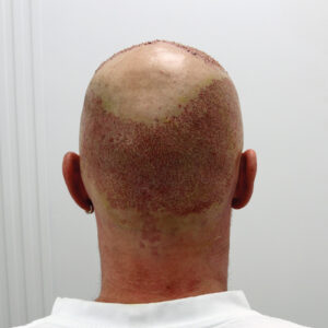 Can Donor Area Be Used Twice