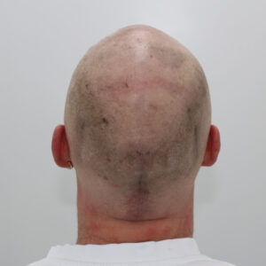 Can Donor Area Be Used Twice