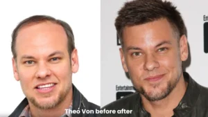 Did Theo Von Get a Hair Transplant