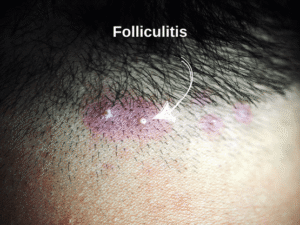Treating Folliculitis After a Hair Transplant